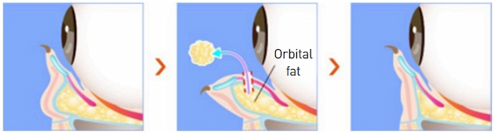経結膜脱脂術で目の下の余分な脂肪を取り除くイラスト