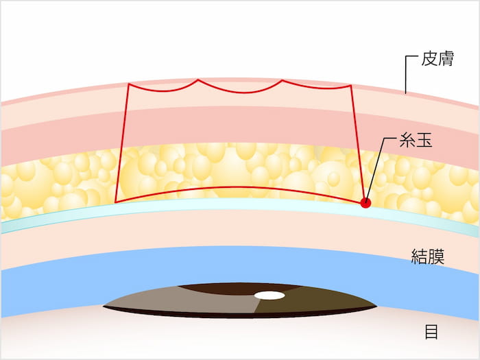経結膜法の画像