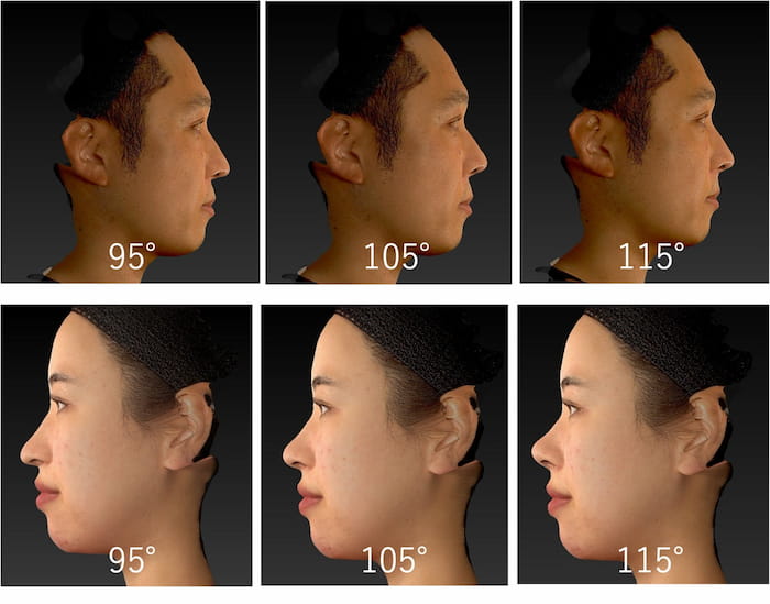 鼻唇角をデジタル加工した画像