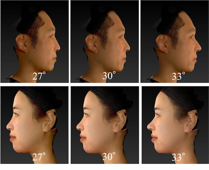 鼻顔角をデジタル加工した画像