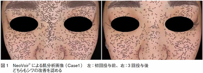 肌育製剤投与前後を肌分析機で分析した画像1