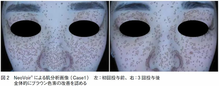 肌育製剤投与前後を肌分析機で分析した画像2