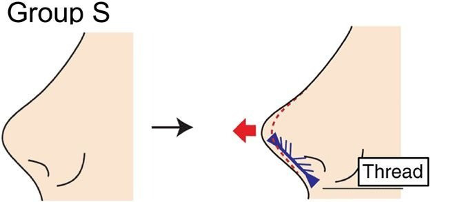 隆鼻術における糸の挿入部位に応じた分類と比較の画像1