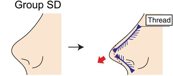 隆鼻術における糸の挿入部位に応じた分類と比較の画像2
