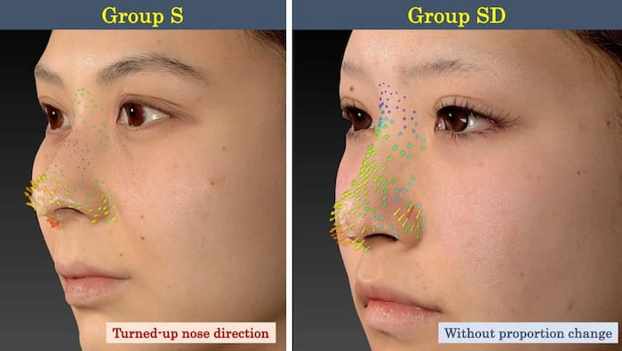 糸の挿入方法の違いによる隆鼻効果を示した画像