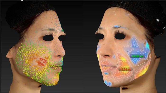 糸リフト後の3D体積変化マップ