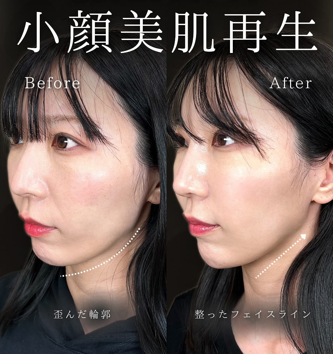 小顔美肌再生の症例写真03
