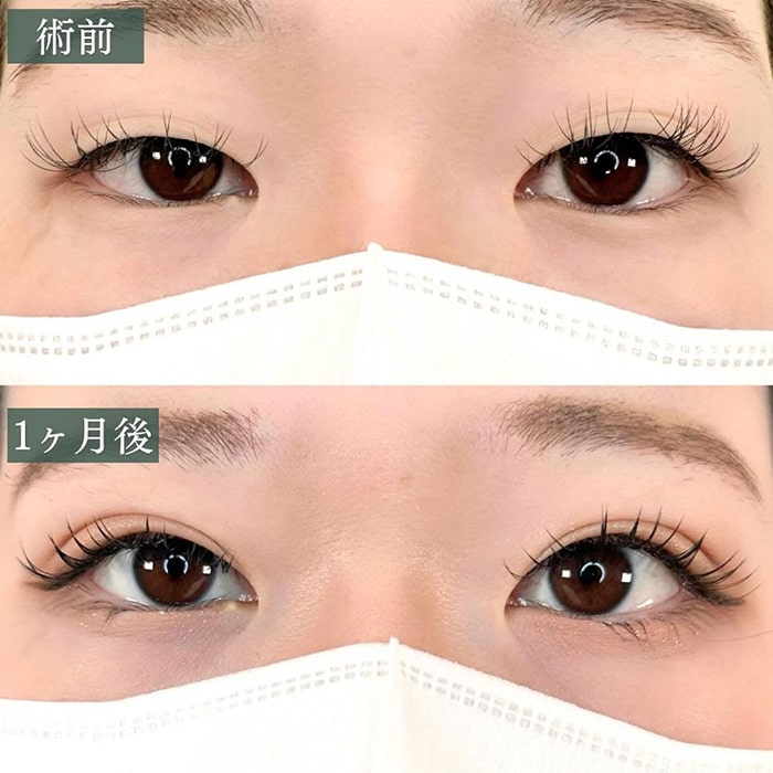 二重埋没の症例写真01