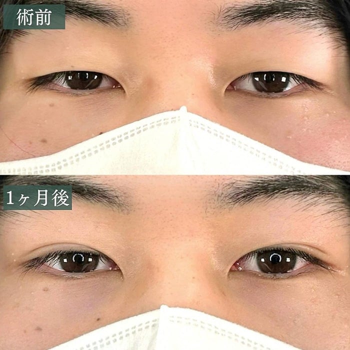 二重埋没の症例写真02