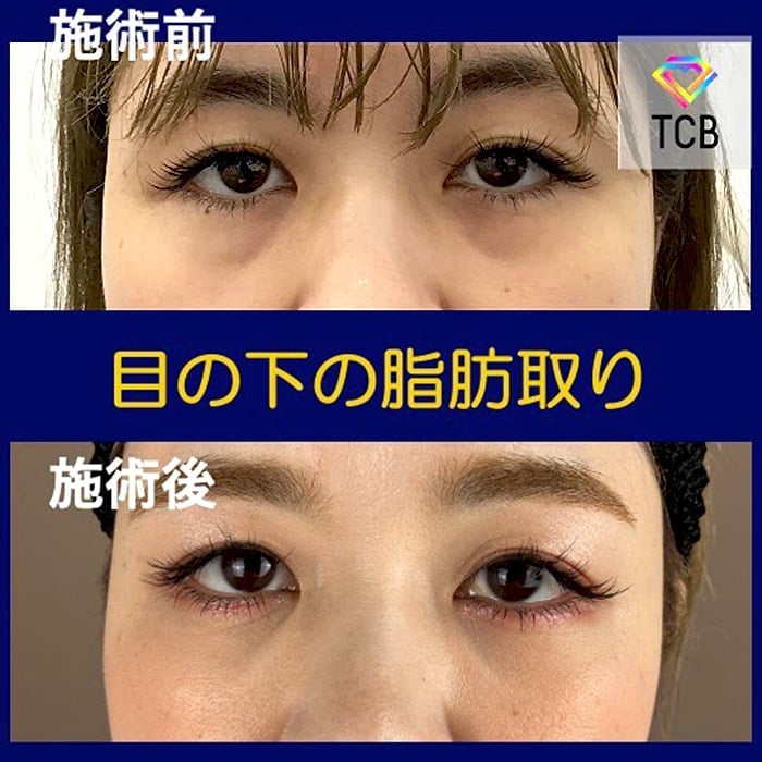 切らない目の下のクマ取り・目の下のたるみ（ふくらみ）取りの症例写真01