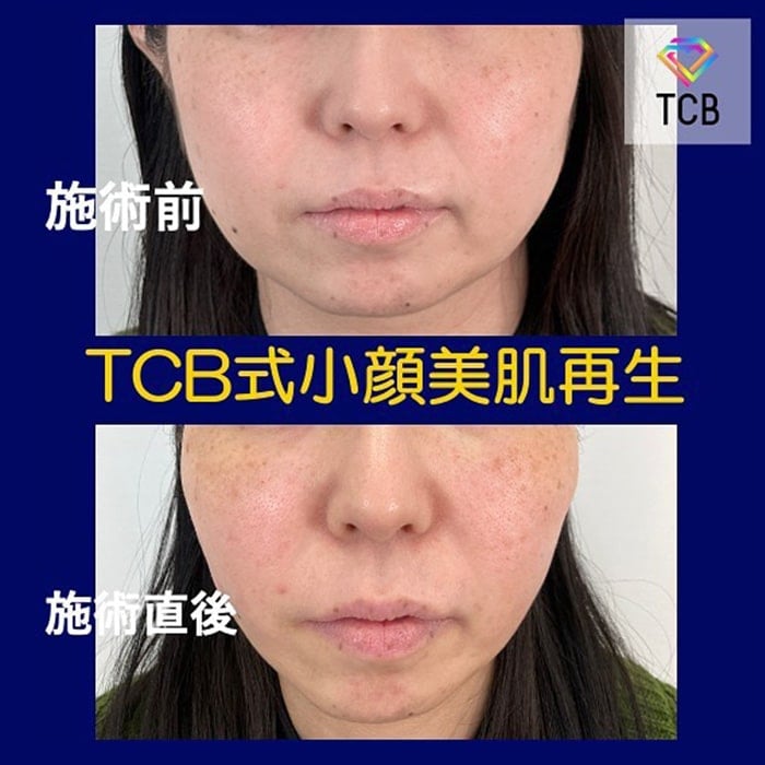 小顔美肌再生の症例写真01