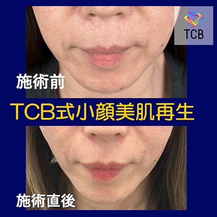 小顔美肌再生の症例写真02