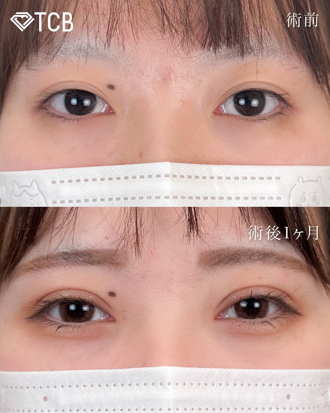 二重埋没の症例写真01