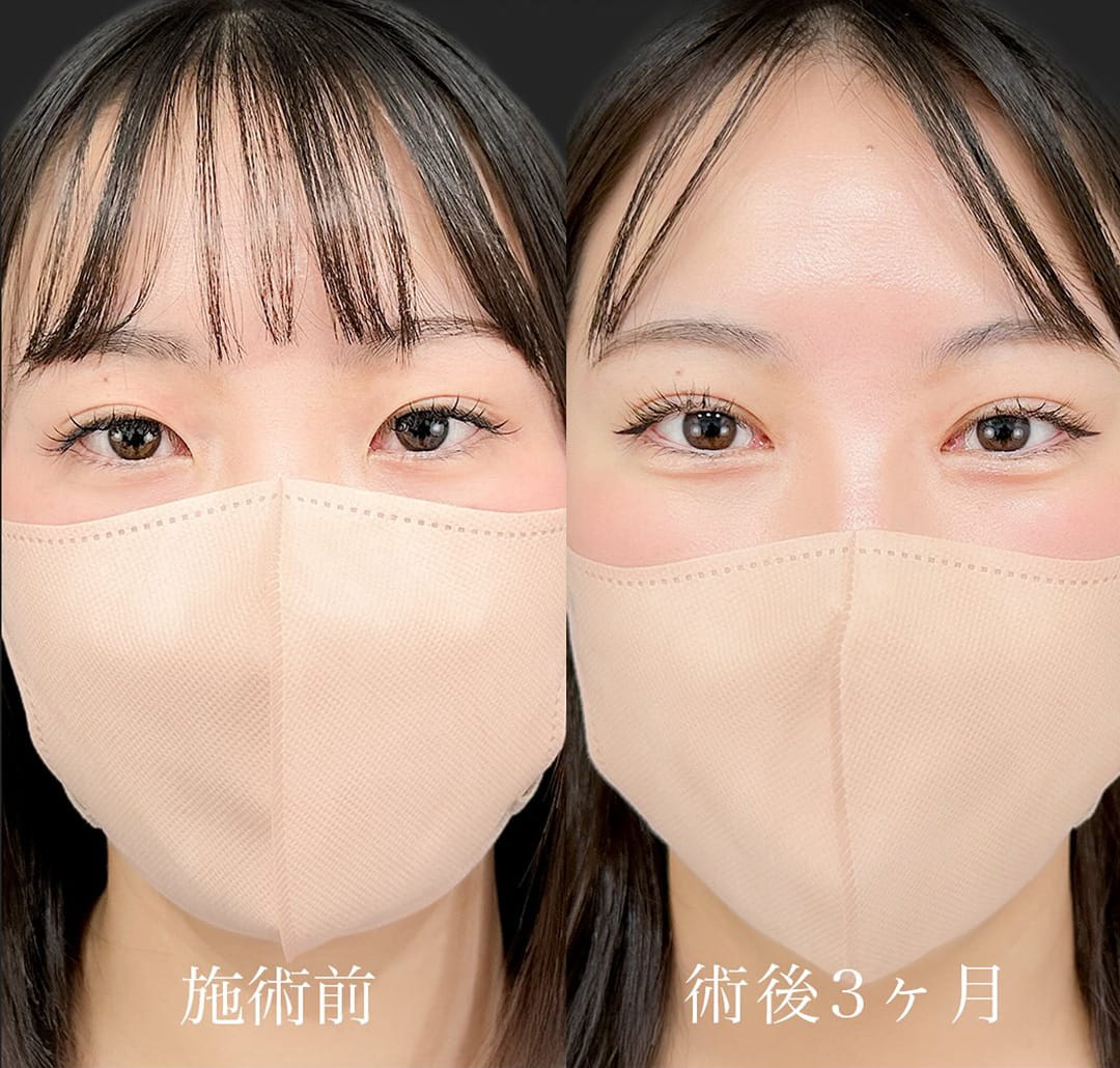 二重埋没の症例写真02