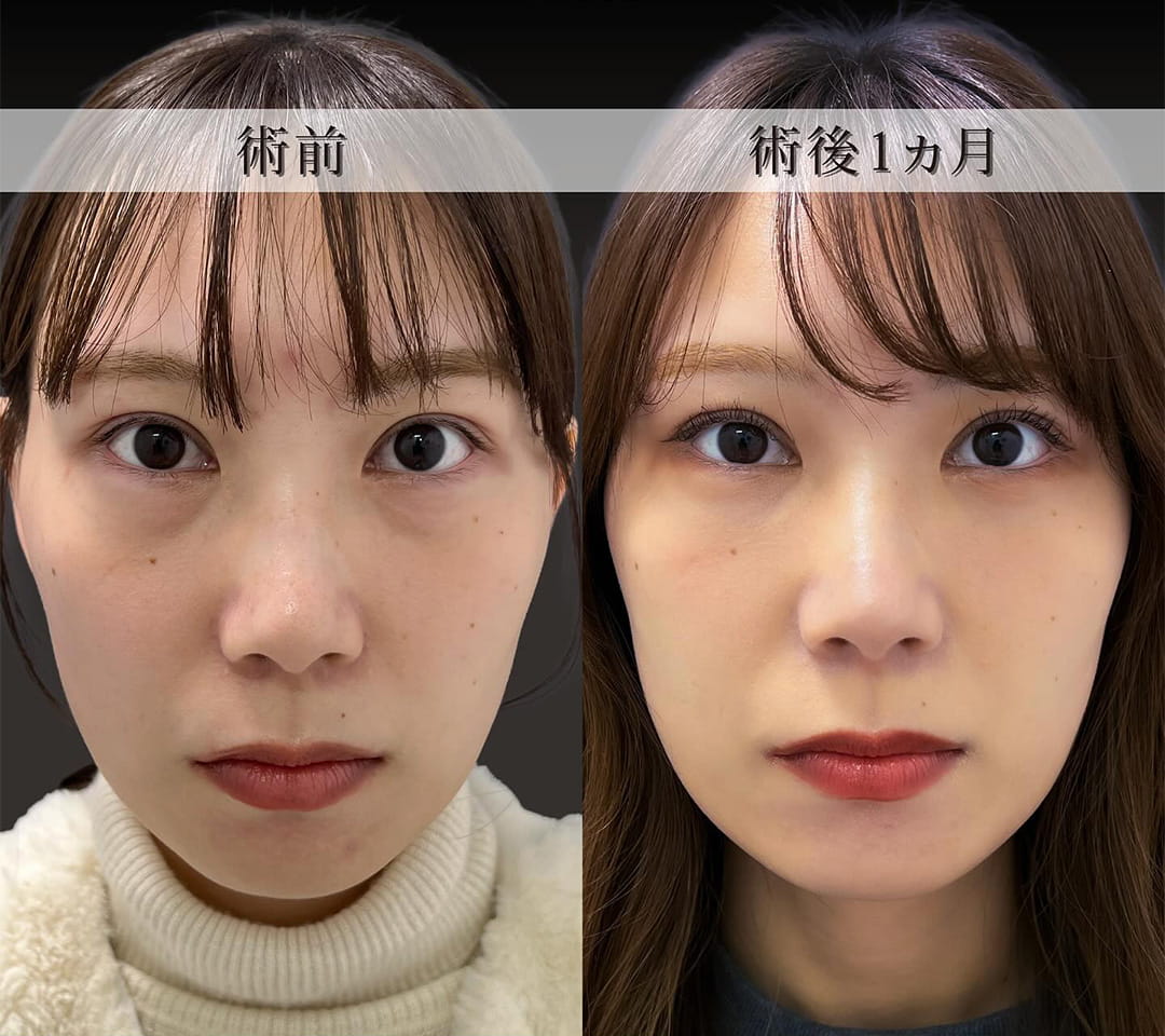 切らない目の下のクマ取り・目の下のたるみ（ふくらみ）取りの症例写真03
