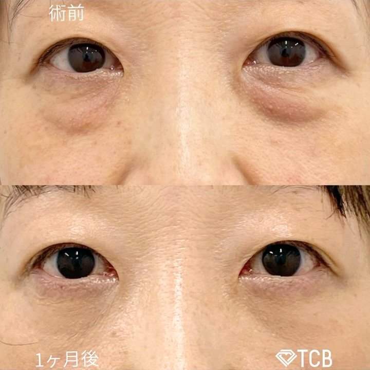 切らない目の下のクマ取り・目の下のたるみ（ふくらみ）取りの症例写真01