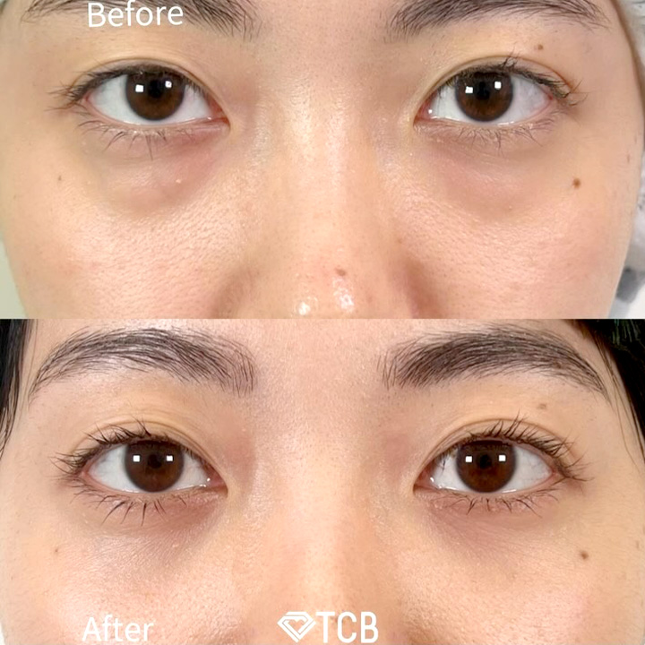 切らない目の下のクマ取り・目の下のたるみ（ふくらみ）取りの症例写真02