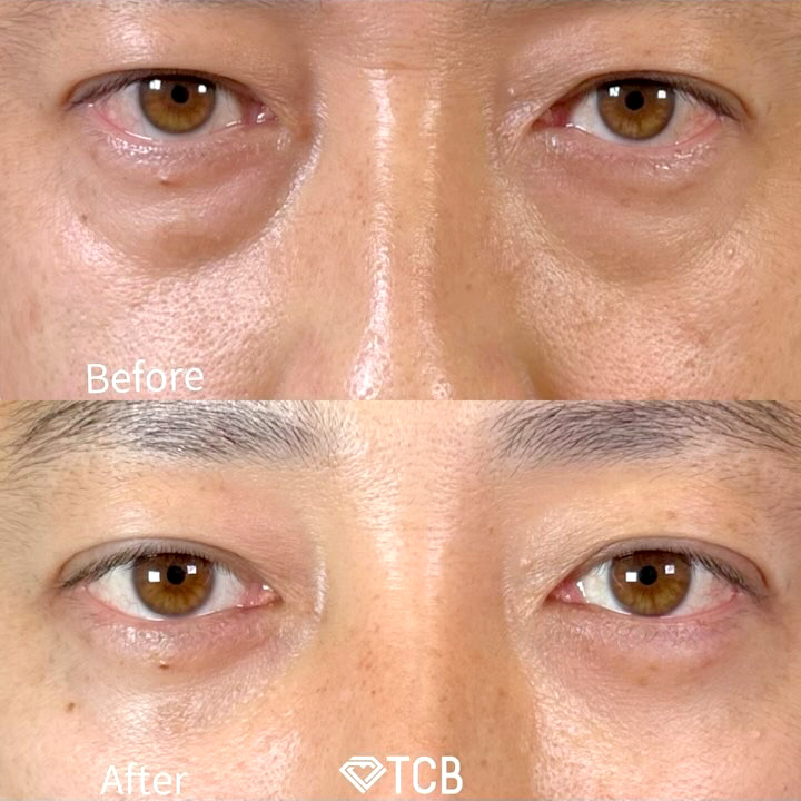 切らない目の下のクマ取り・目の下のたるみ（ふくらみ）取りの症例写真03