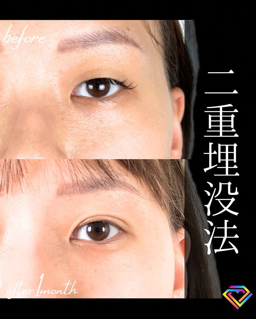 二重埋没の症例写真01