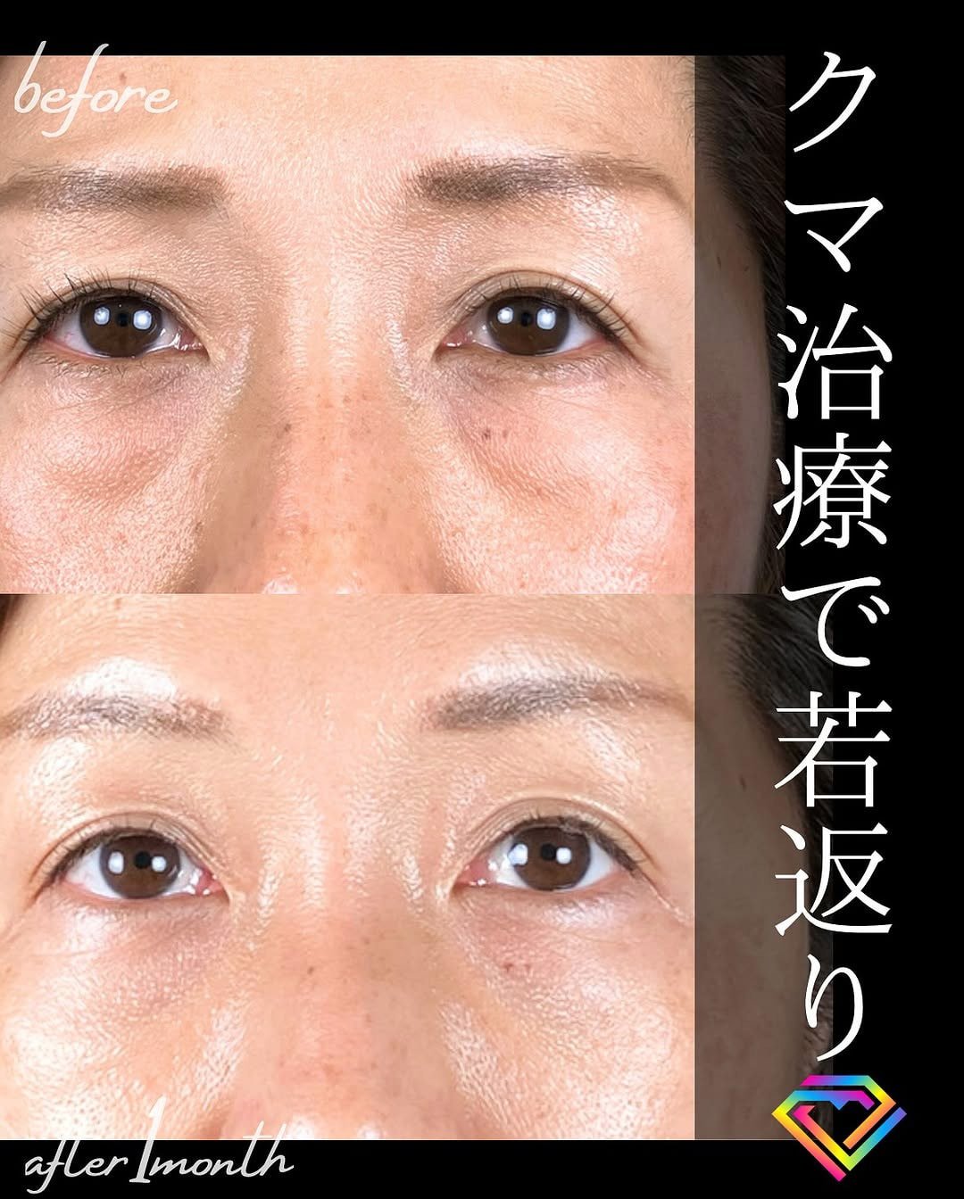 切らない目の下のクマ取り・目の下のたるみ（ふくらみ）取りの症例写真02