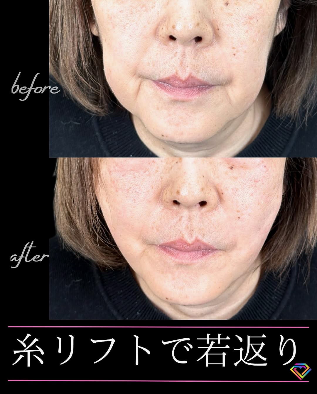 小顔美肌再生の症例写真01