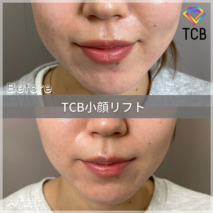 TCB小顔リフトの症例写真01