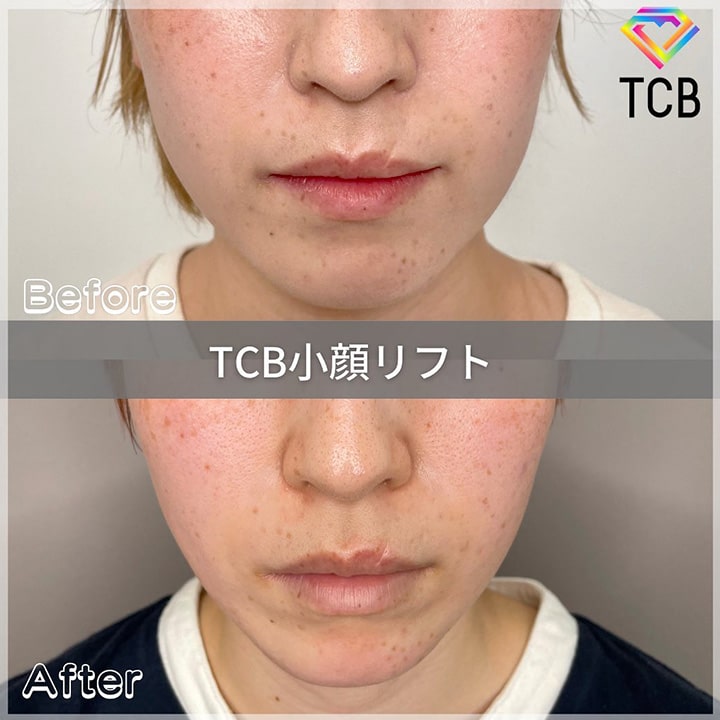 TCB小顔リフトの症例写真02