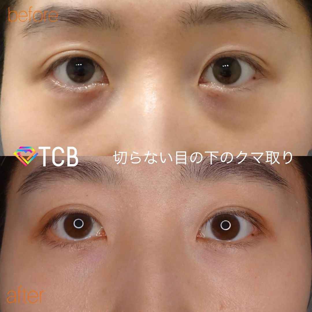 切らない目の下のクマ取り・目の下のたるみ（ふくらみ）取りの症例写真01