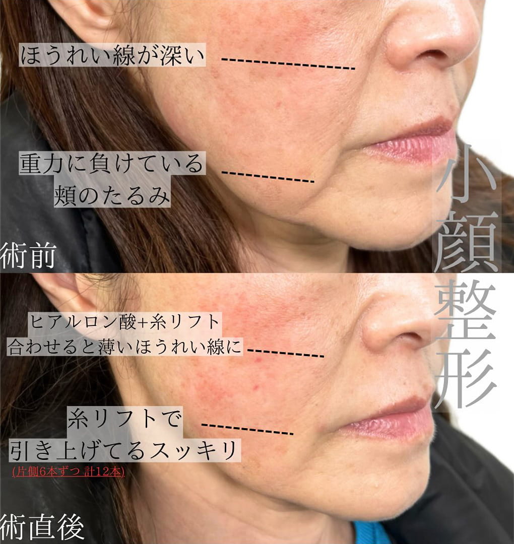 小顔美肌再生の症例写真01