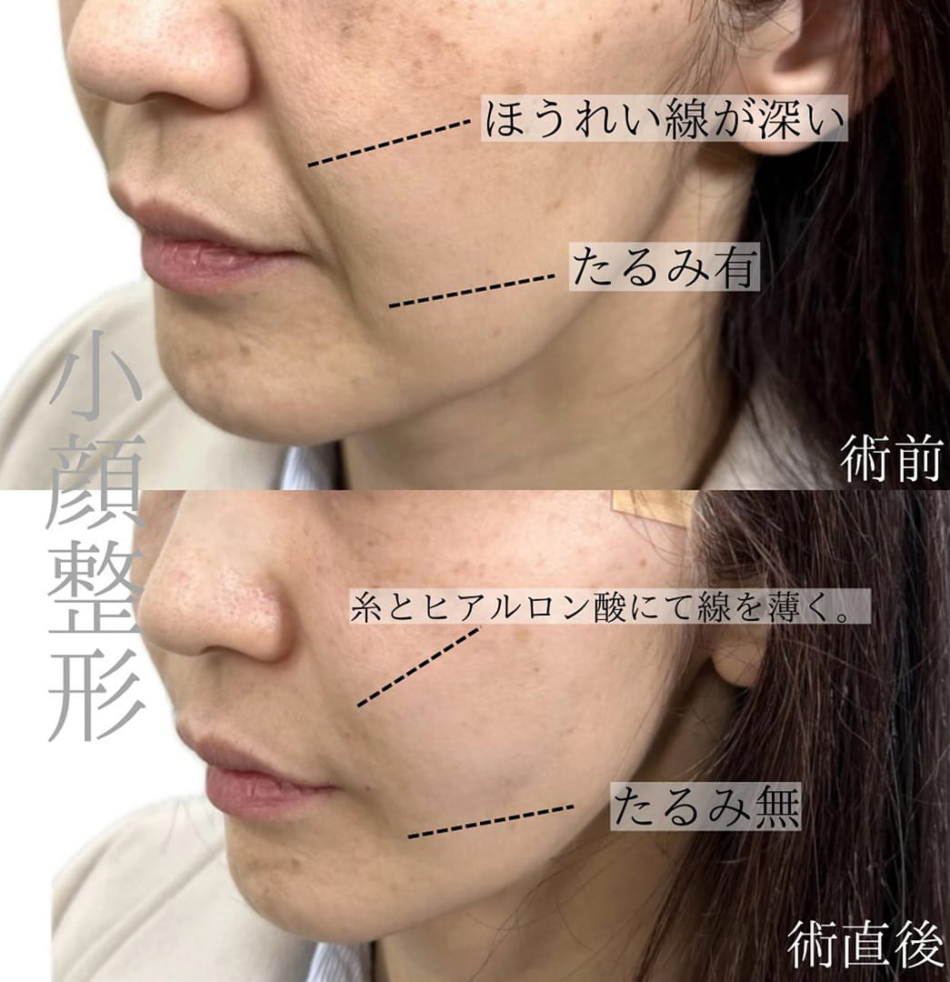 小顔美肌再生の症例写真02