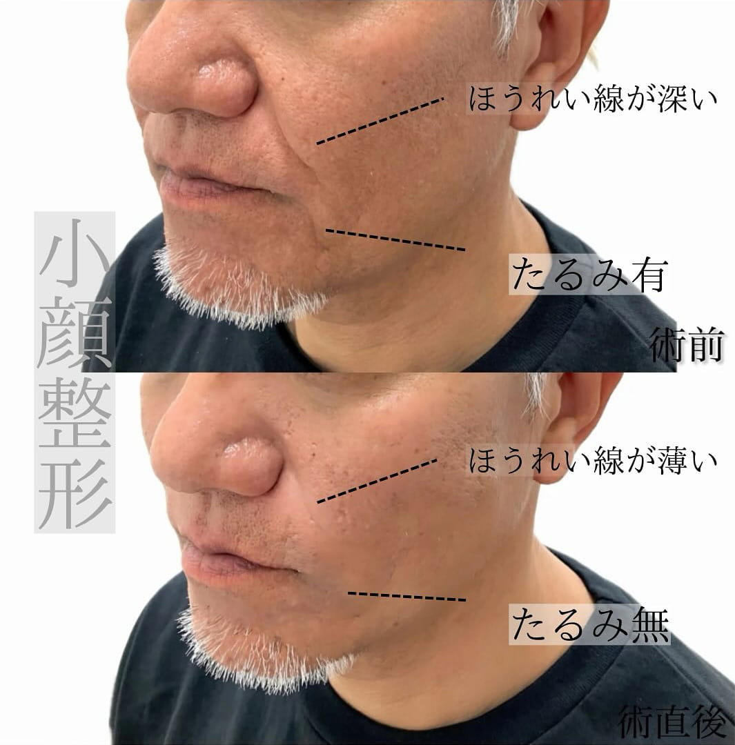 小顔美肌再生の症例写真03