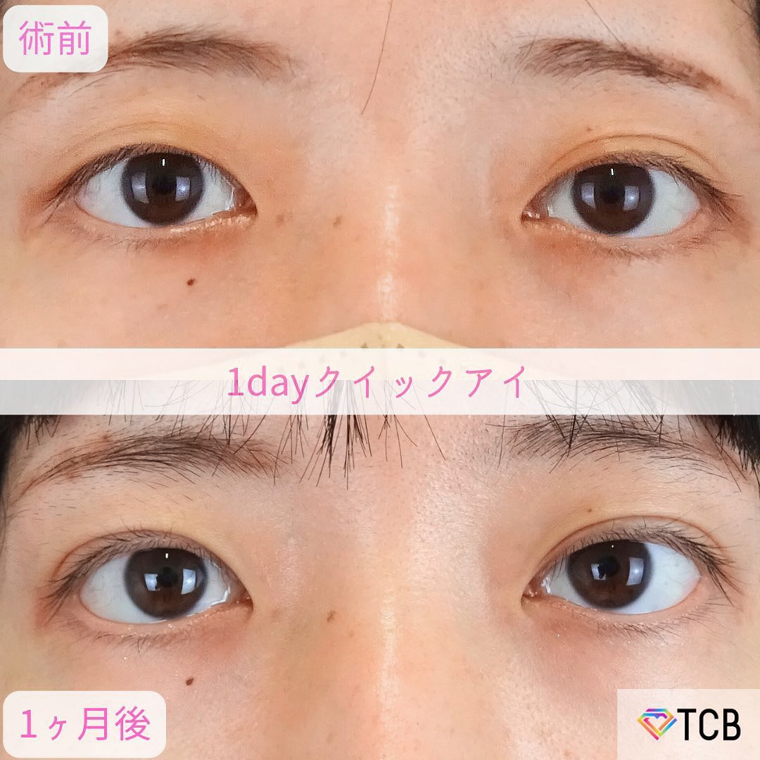 二重埋没の症例写真01