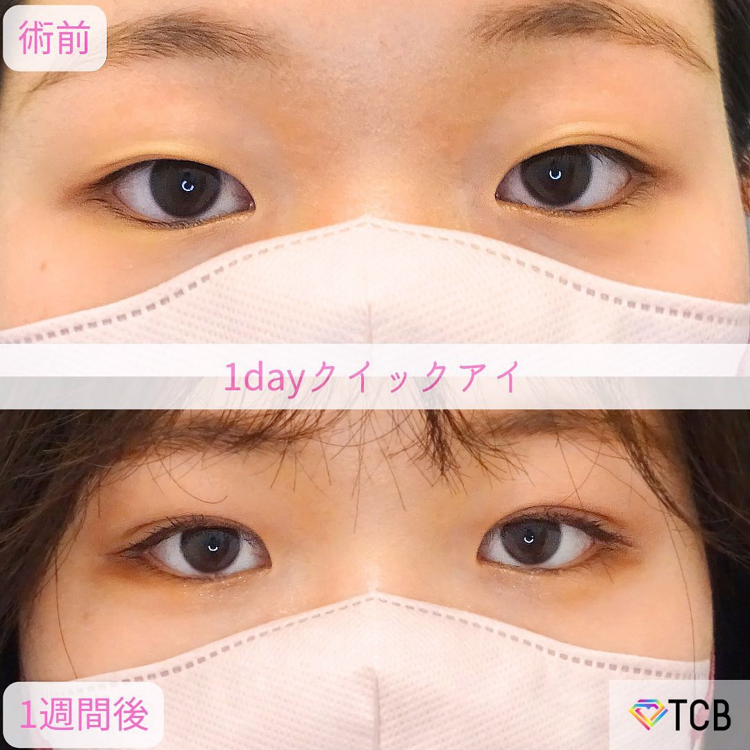 二重埋没の症例写真02