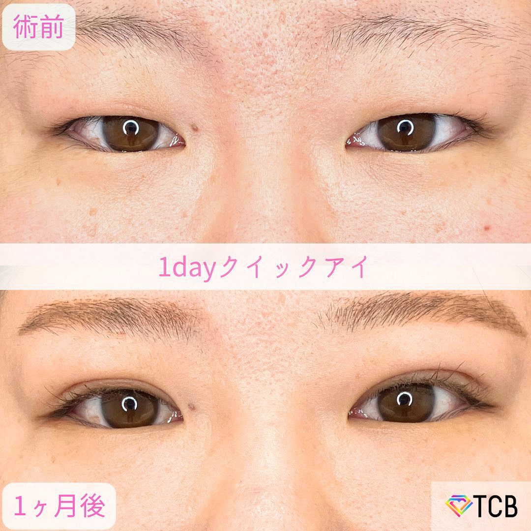二重埋没の症例写真03