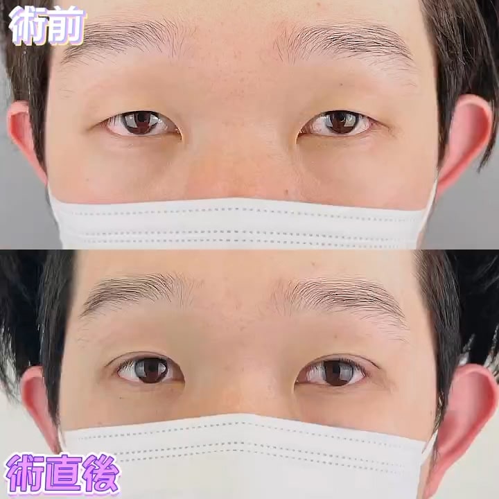 二重埋没の症例写真04
