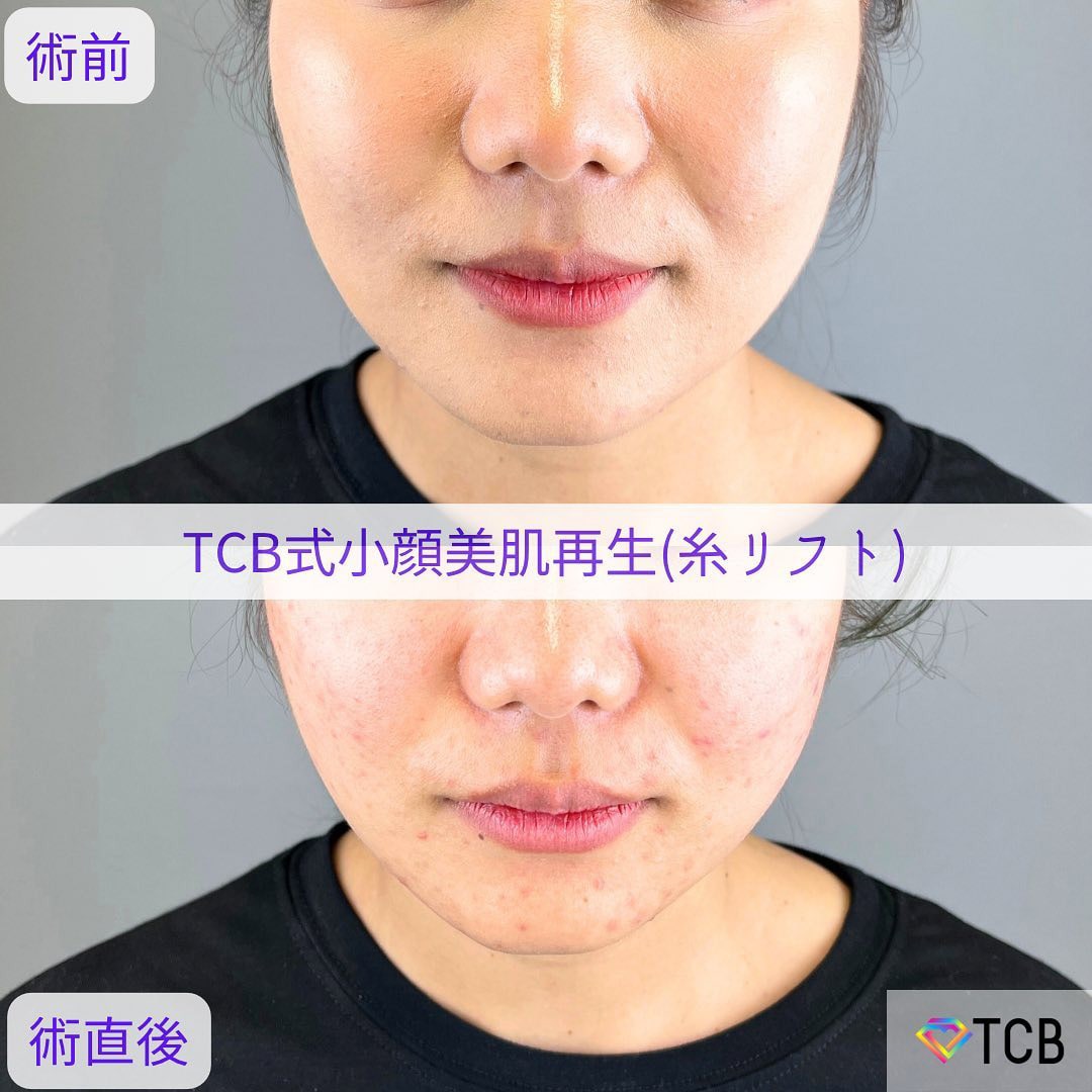 小顔美肌再生の症例写真01