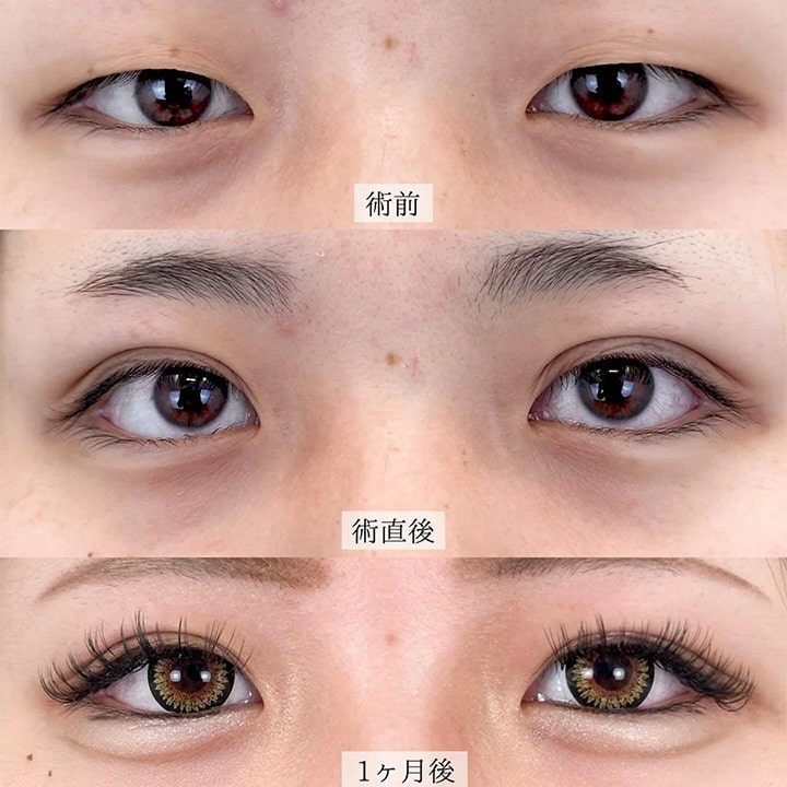 二重埋没の症例写真01