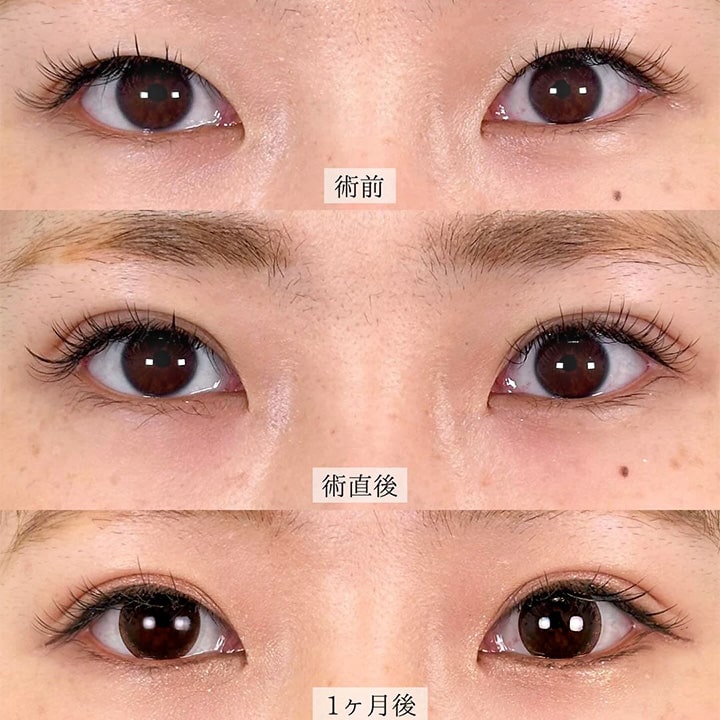 二重埋没の症例写真02