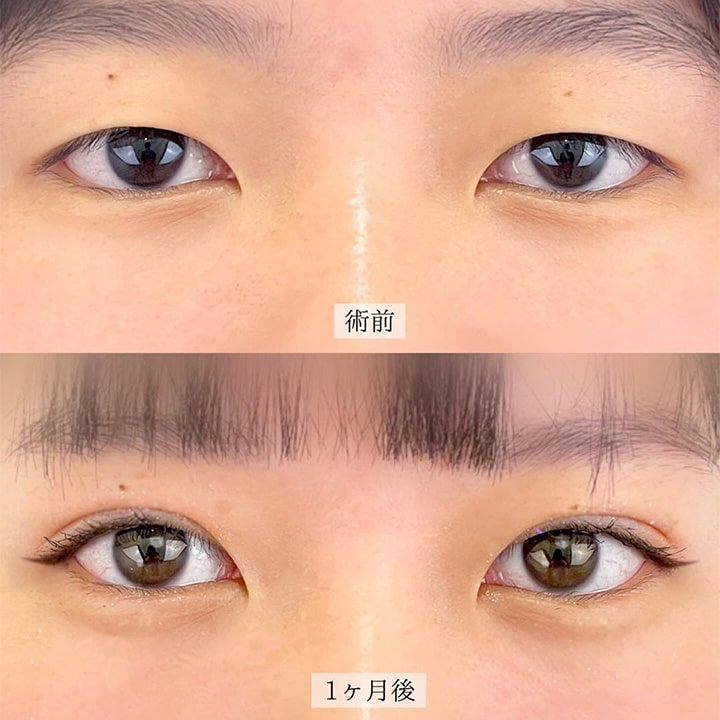 二重埋没の症例写真03