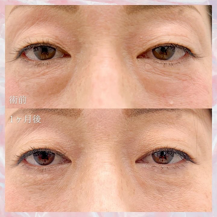 切らない目の下のクマ取り・目の下のたるみ（ふくらみ）取りの症例写真01