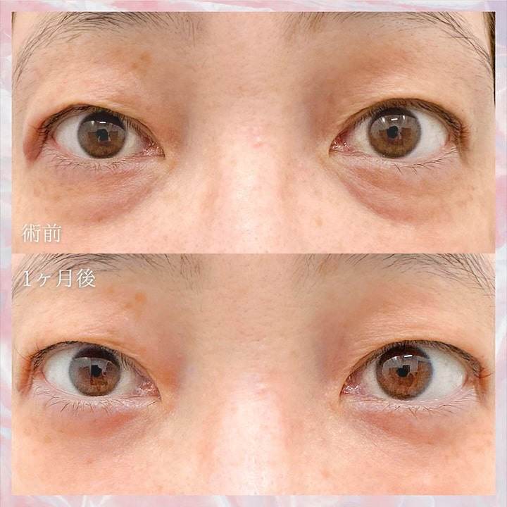 切らない目の下のクマ取り・目の下のたるみ（ふくらみ）取りの症例写真02