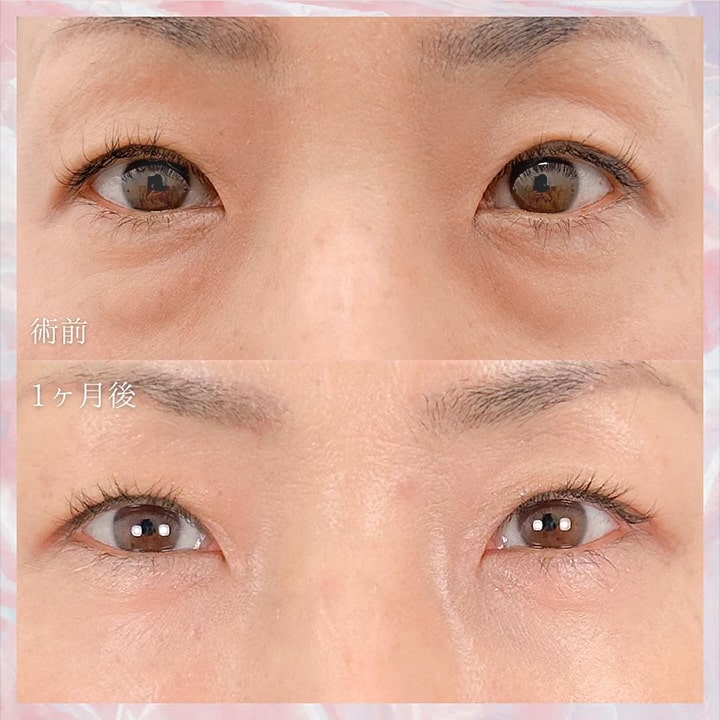 切らない目の下のクマ取り・目の下のたるみ（ふくらみ）取りの症例写真03