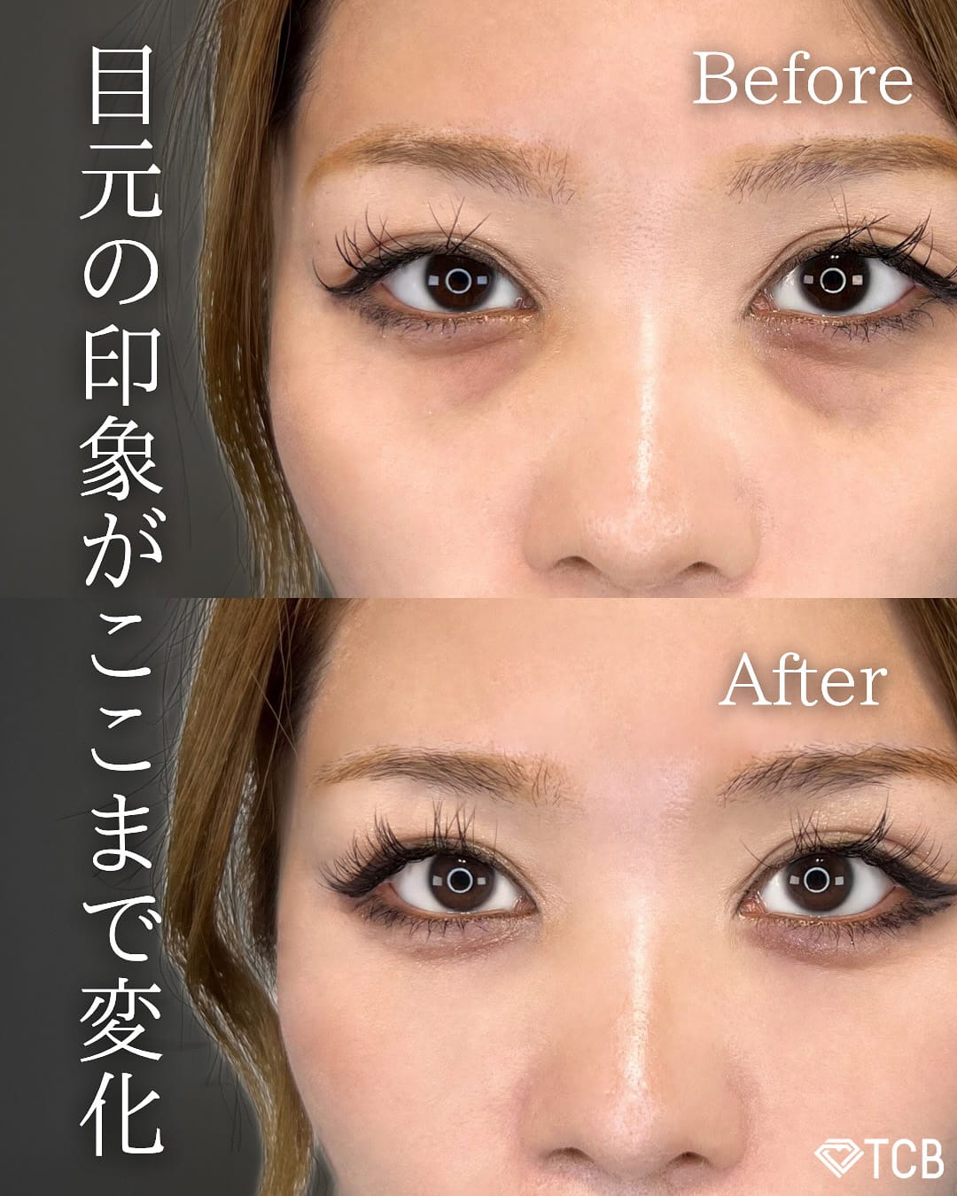 切らない目の下のクマ取り・目の下のたるみ（ふくらみ）取りの症例写真01