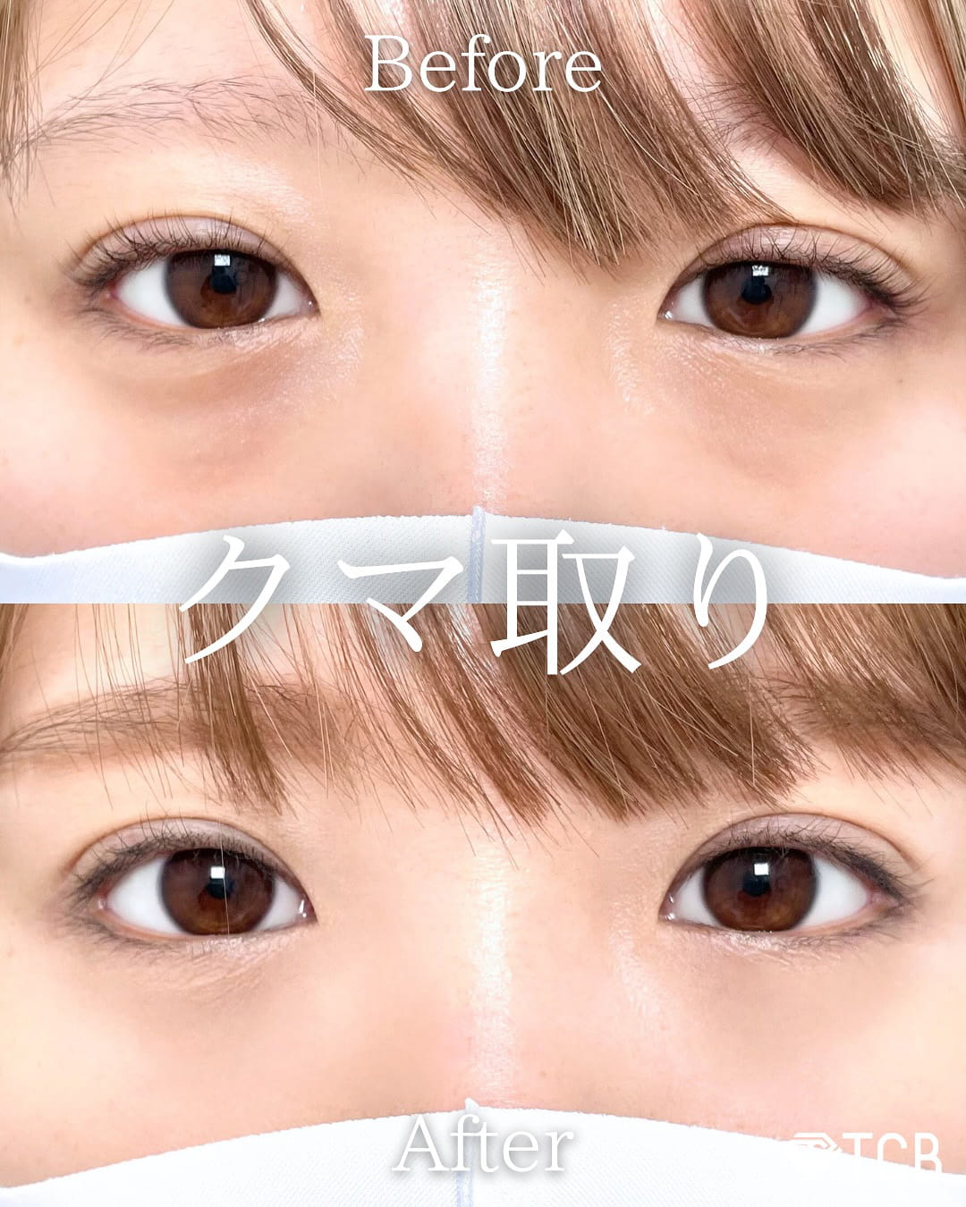 切らない目の下のクマ取り・目の下のたるみ（ふくらみ）取りの症例写真03