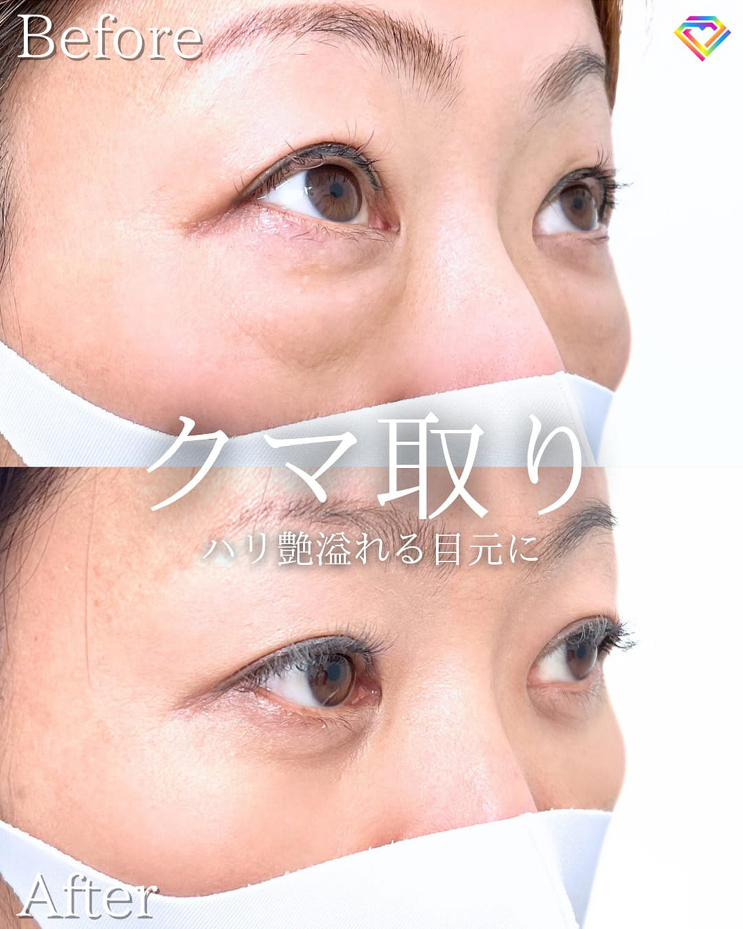 切らない目の下のクマ取り・目の下のたるみ（ふくらみ）取りの症例写真04