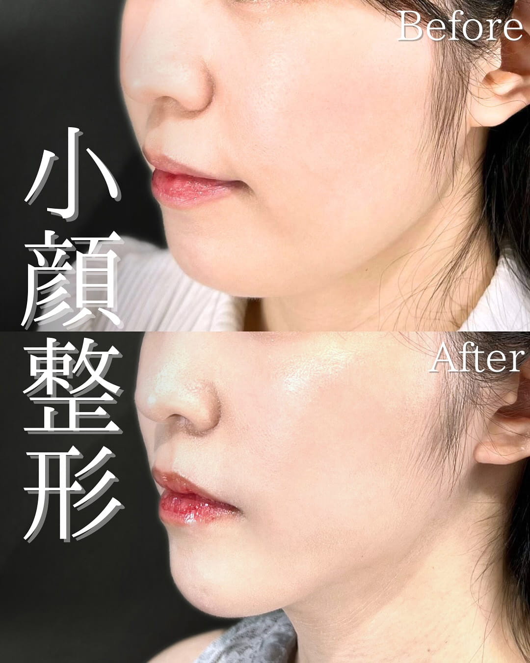 小顔美肌再生の症例写真02