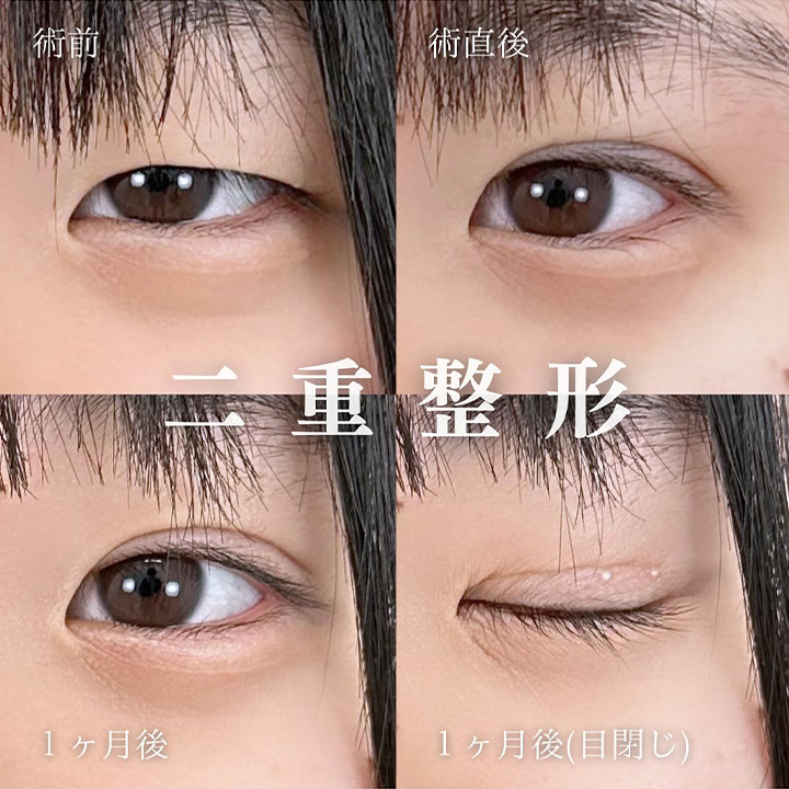 二重埋没の症例写真01