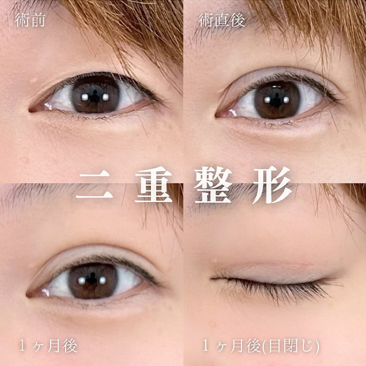 二重埋没の症例写真02