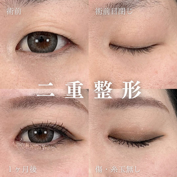 二重埋没の症例写真03