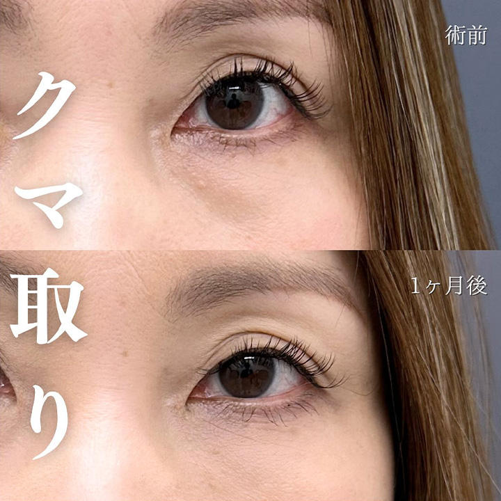 切らない目の下のクマ取り・目の下のたるみ（ふくらみ）取りの症例写真01